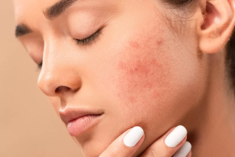 Top Eczema Creams in Pakistan: Dermatologist Tips