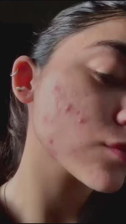 Spotless - Anti Acne Serum